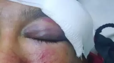 Partido sangriento en City Bell: Denuncia por brutal golpiza en manada